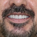 Clínica Dentária e Estética protese removivel sobre implantes